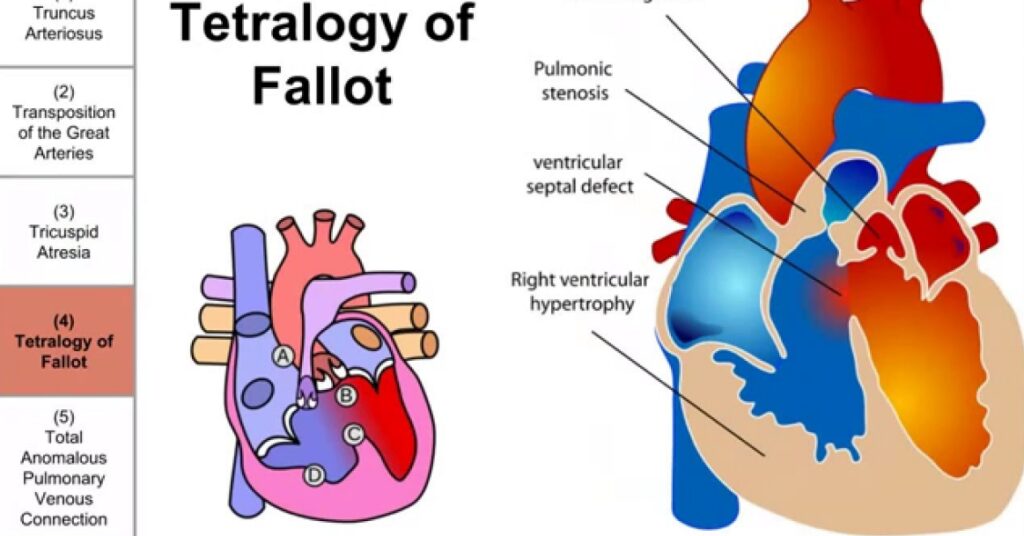 International Day of Congenital Heart Awareness February 14