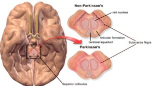 World Day of Parkinson's Disease April 11