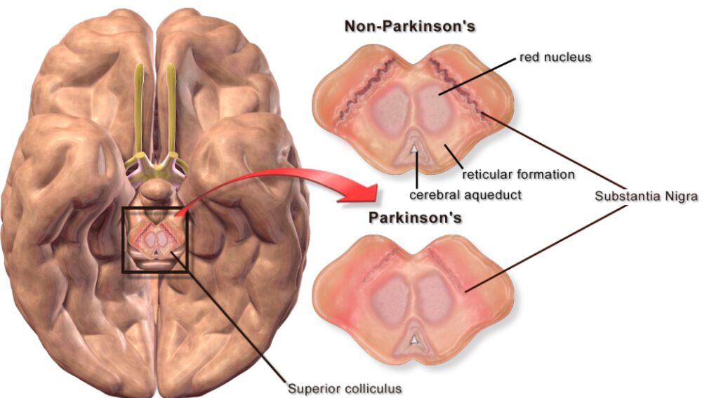 World Day of Parkinson’s Disease April 11