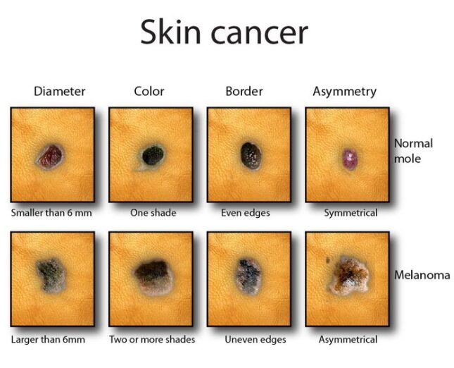 National Day of Skin Cancer Screening May 26