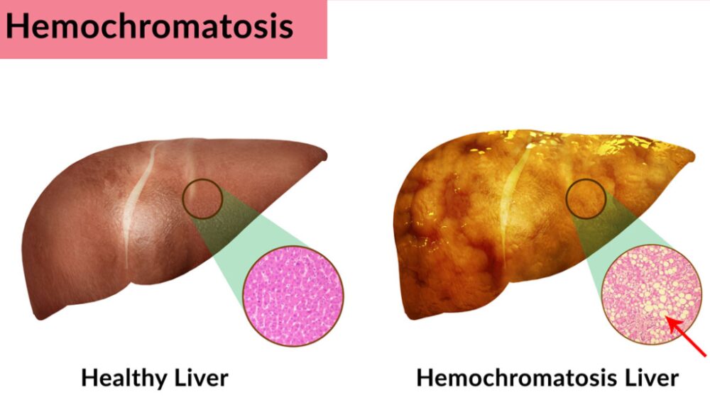 National Hemochromatosis Awareness Week June 02