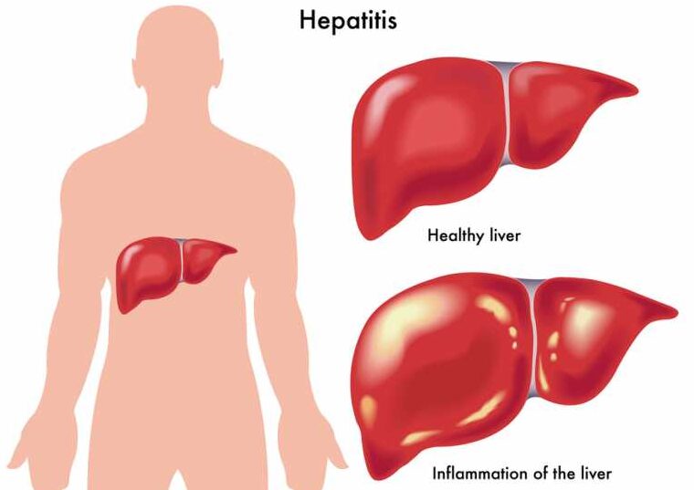 World Day Against Hepatitis July 28