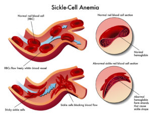 World Sickle Cell Day June 19