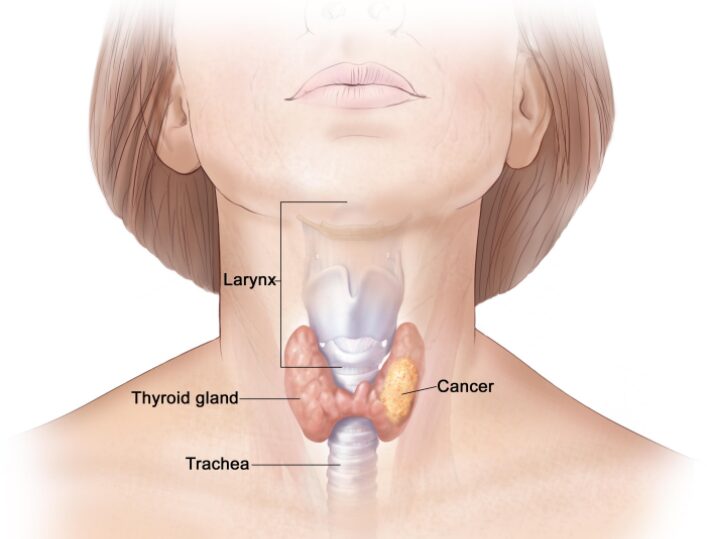World Thyroid Day May 25