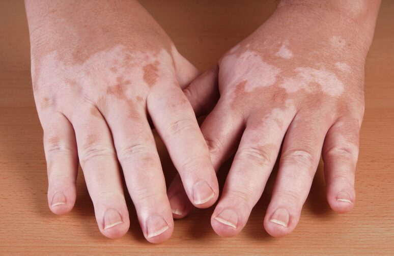 World Vitiligo Day June 24