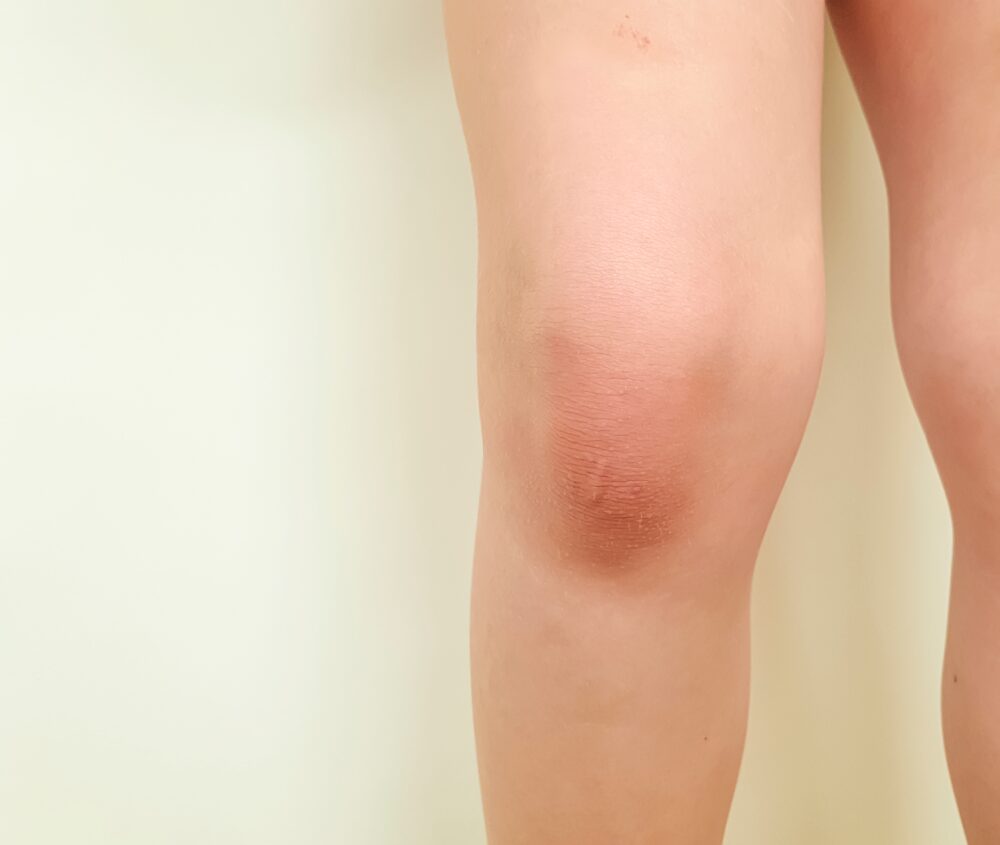 swollen-knees-1566317866