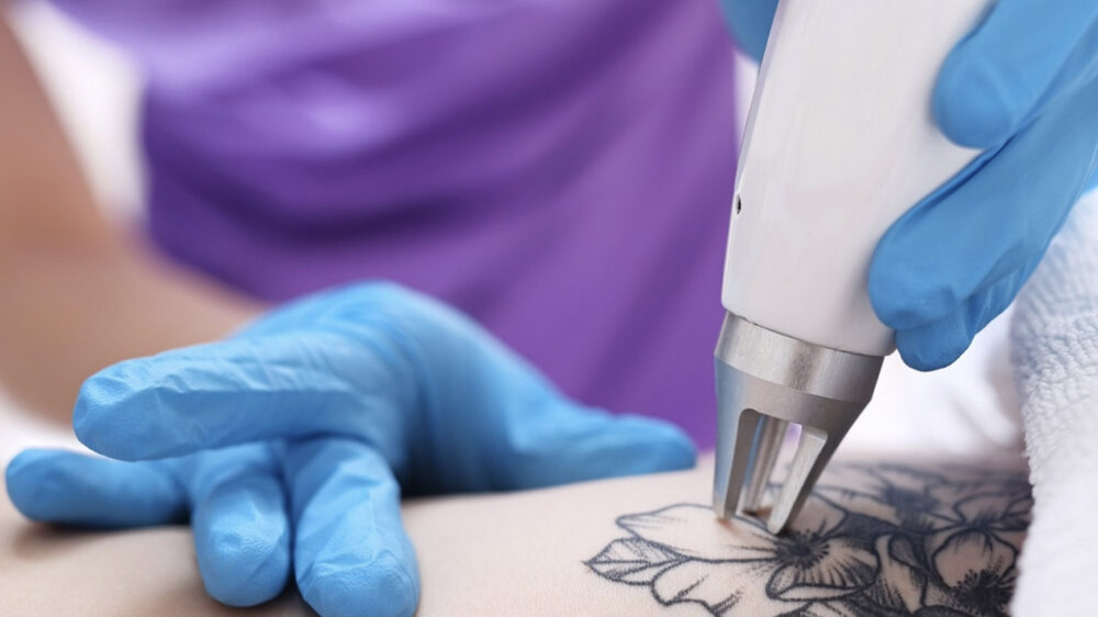 tattoo-removal (1)