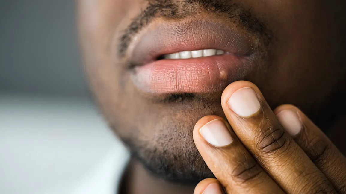 male-oral-herpes-on-mouth-1296-728-header